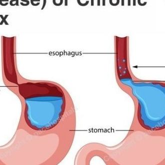 What is are gastroesophageal reflux disease symptoms?